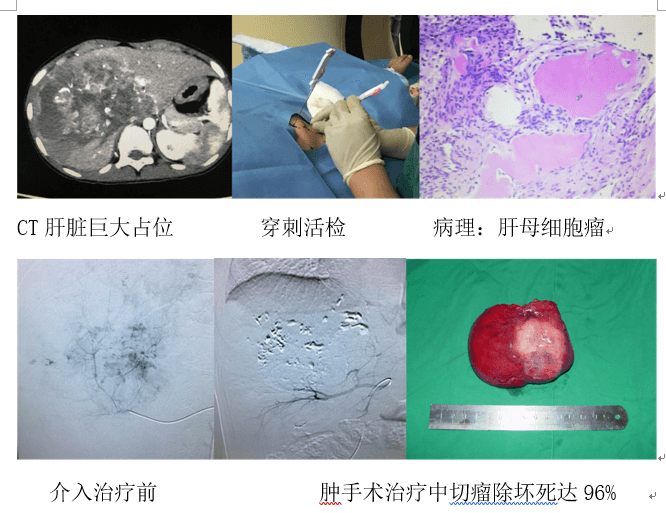 介入科醫(yī)生李炯：兒童出血性疾病、實(shí)體惡性腫瘤的介入治療