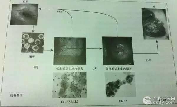 等了10年！宮頸癌疫苗終于要在內(nèi)地上市，就在明年年初！轉(zhuǎn)給身邊所有的女性！