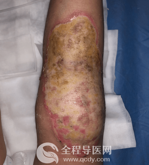 2歲男娃腿燙傷自敷草藥治療致高熱驚厥-兒童醫(yī)院燒傷科醫(yī)生談：燙傷應(yīng)如何處理？