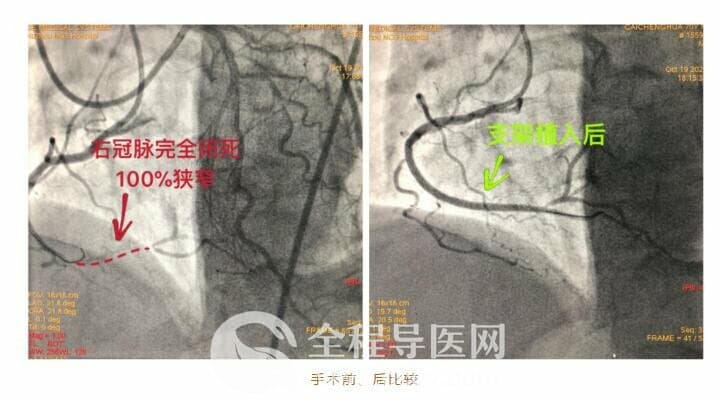 徐州市三院心臟團隊于長城心臟病學(xué)大會CTO論壇直播超高難度冠心病介入手術(shù)