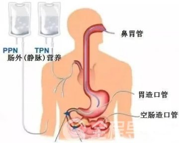 徐州一院重癥醫(yī)學科：營養(yǎng)治療的重要性，你了解嗎？